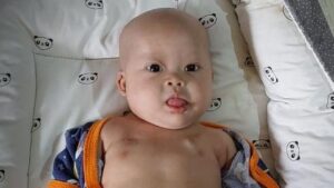 Kisah Chiara, Bayi 8 Bulan Berjuang Melawan Tumor Ganas dan Kondisi Langka Lainnya