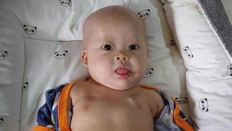 Kisah Chiara, Bayi 8 Bulan Berjuang Melawan Tumor Ganas dan Kondisi Langka Lainnya